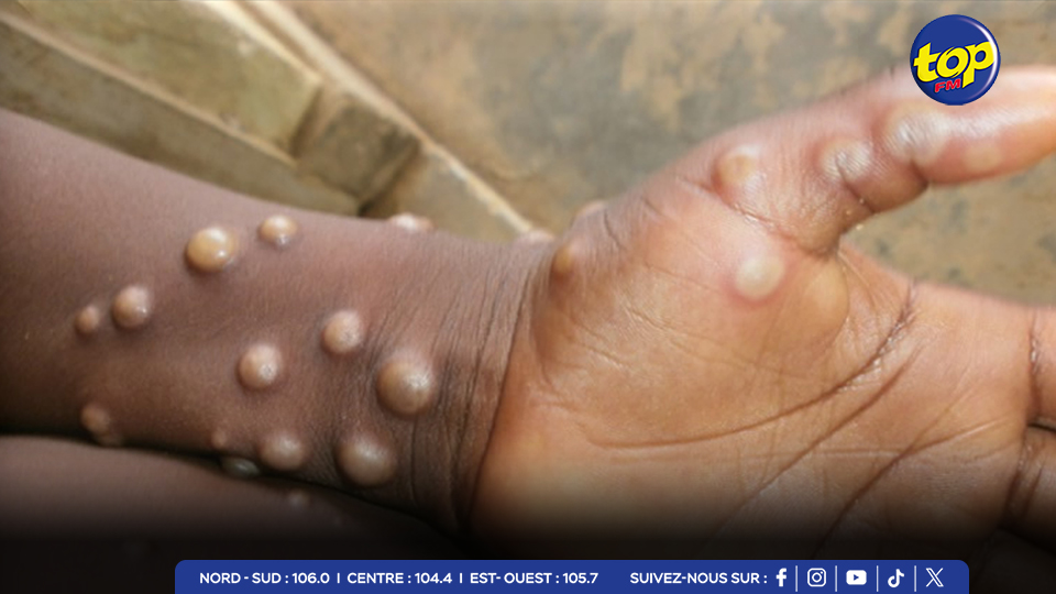 elle continue de progresser dans la région de Goma à l'est du pays L’'épidémie de mpox s’aggrave en République démocratique du Congo :