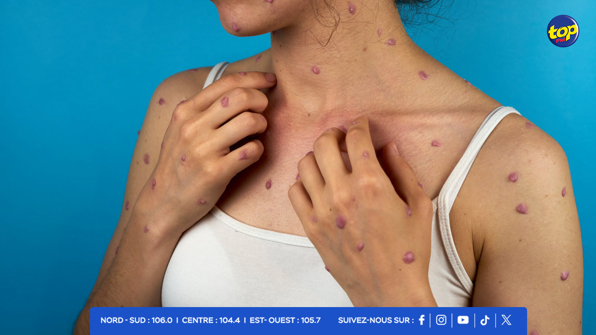 Mpox ou variole du-singe Mpox ou variole du-singe